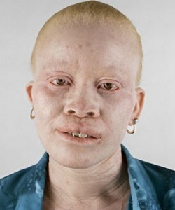 Albino Kenyan