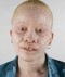 Major problems facing Albinos in Africa
